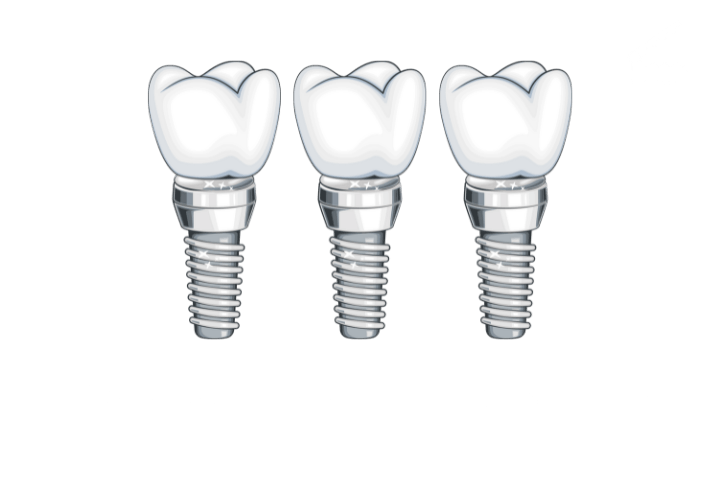 Моделирование и печать - 3 импланта