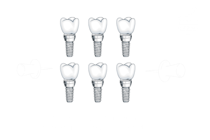 Моделирование и печать - разборный хирургический шаблон All-on-4/6