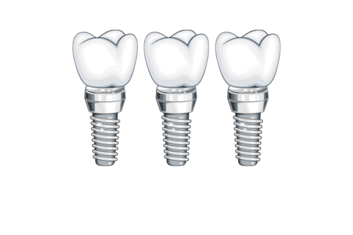 Моделирование и печать - 3 импланта